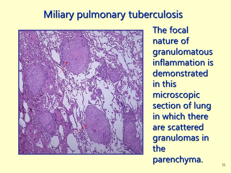 The focal nature of granulomatous inflammation is demonstrated in this microscopic section of lung